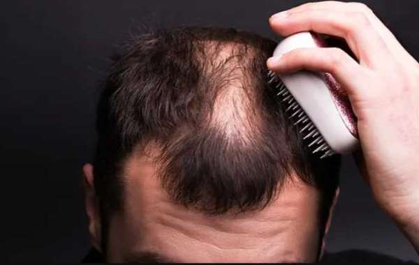 Tips And Tricks To Understand Before You Go For Hair Transplant Essex