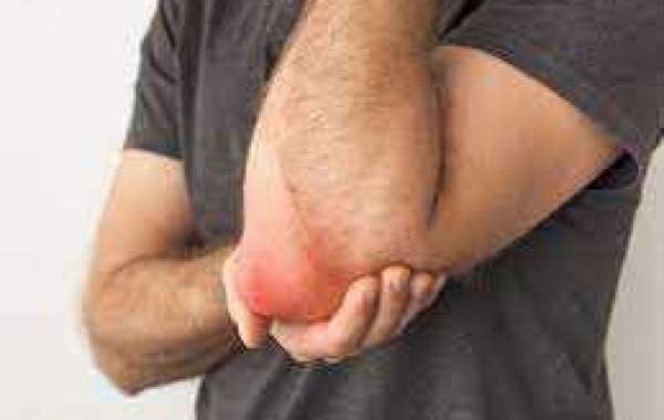 The Effective Relief of Elbow Pain Offered by Tapentadol