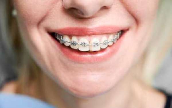 Embrace Your Smile: A Comprehensive Guide to Adult Braces