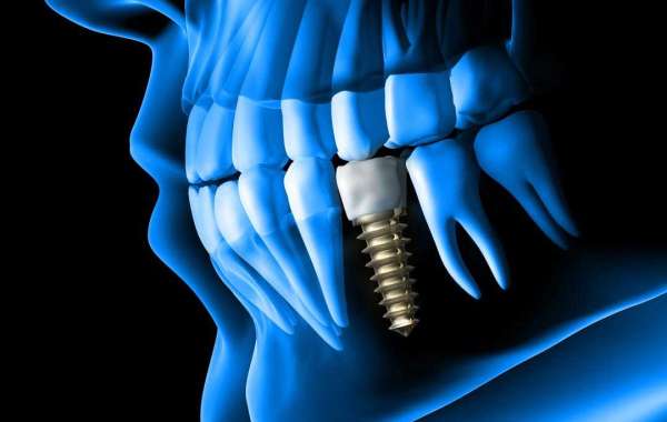 Discover the Pinnacle of Oral Health: Top-Rated Dental Implants in Dubai